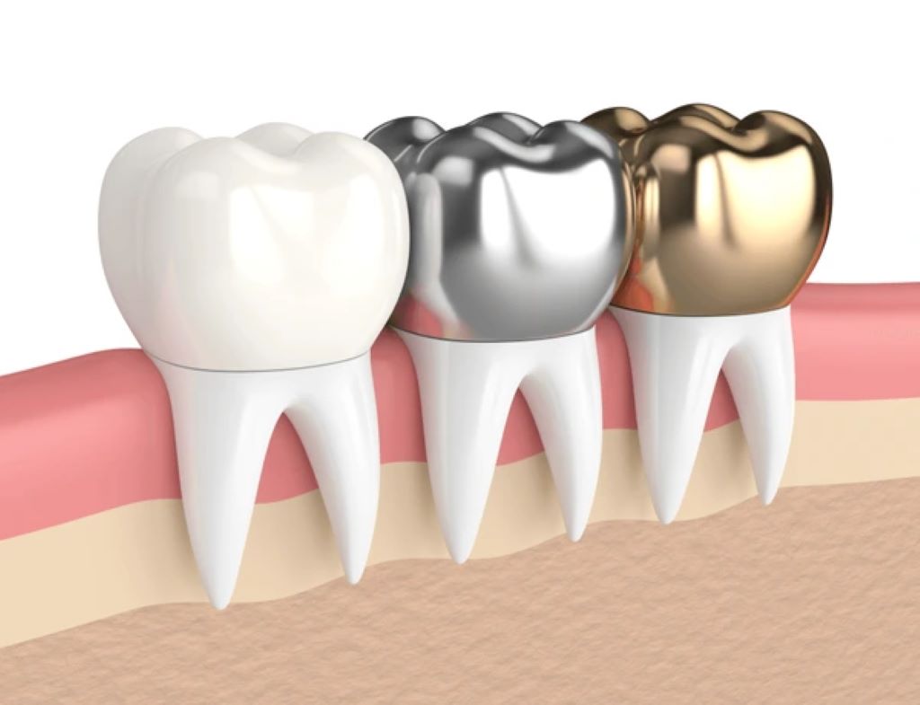 dental-crowns-near-you