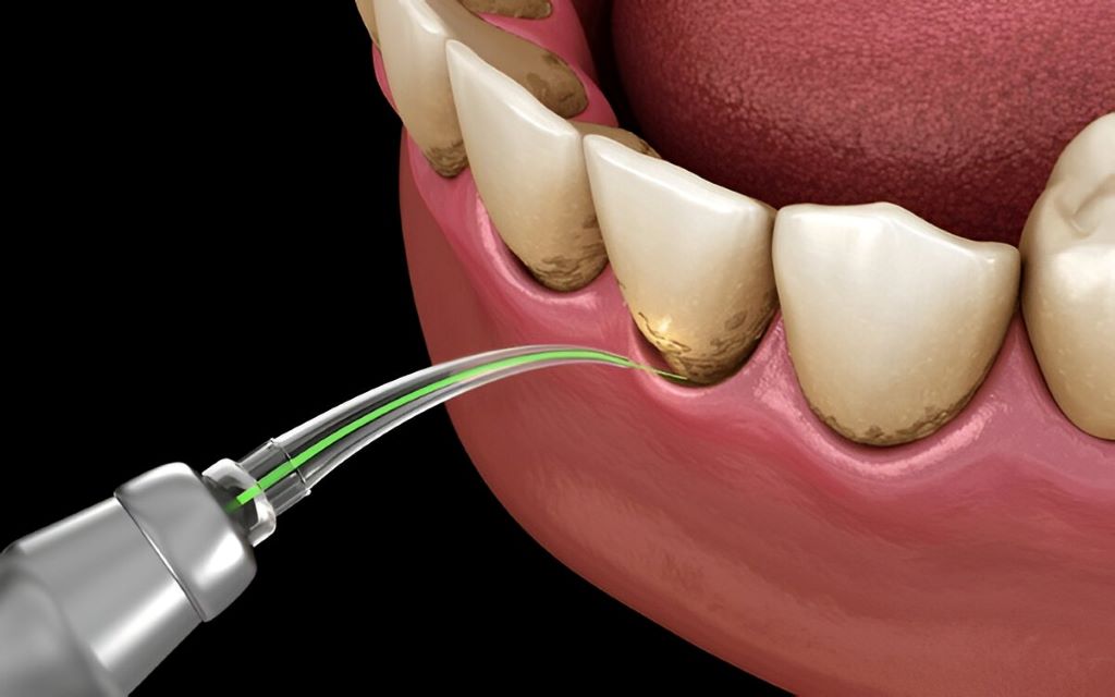 laser-dentistry-near-you