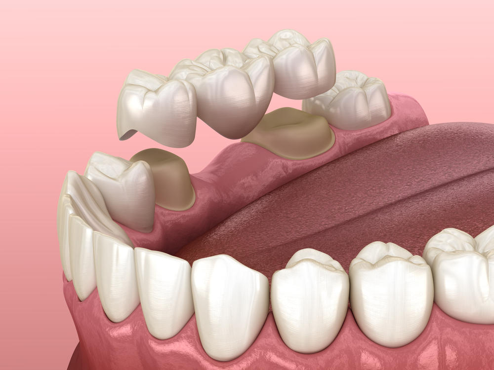what-are-dental-crowns-a-simple-guide-for-new-patients