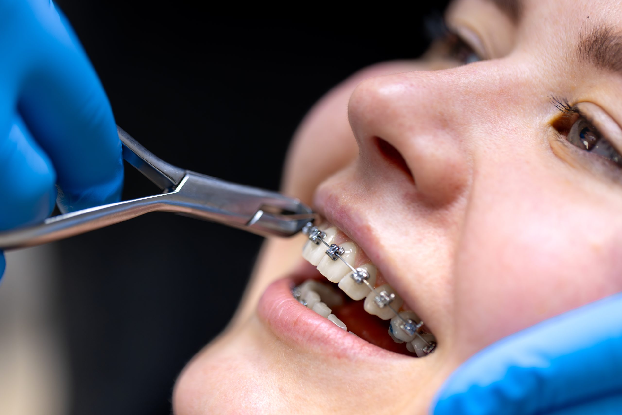 Step-by-Step Guide to Clean Braces Like a Professional